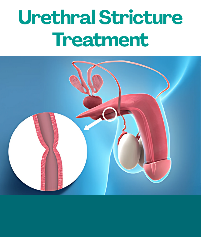 Urethral Stricture Treatment in Hyderabad