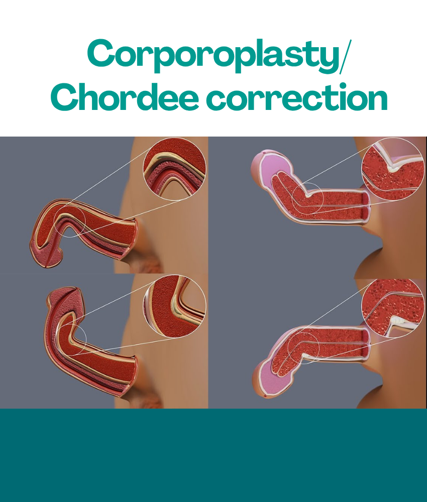 Corporoplasty Chordee correction