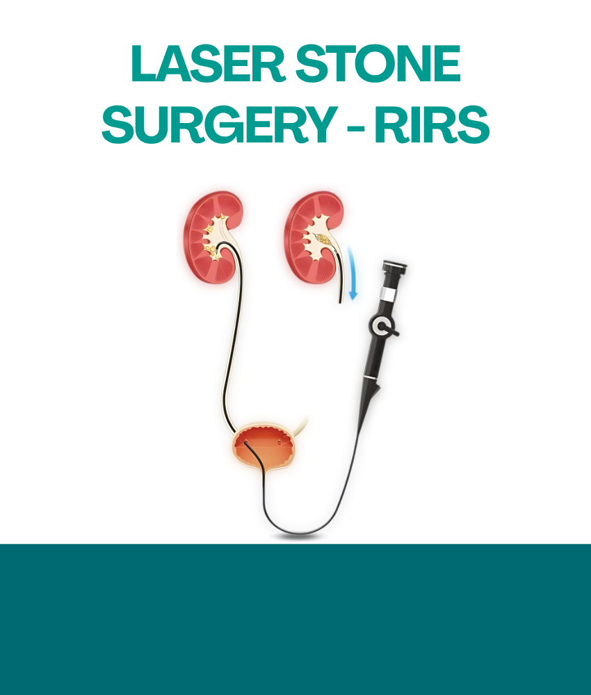 LASER STONE SURGERY - RIRS