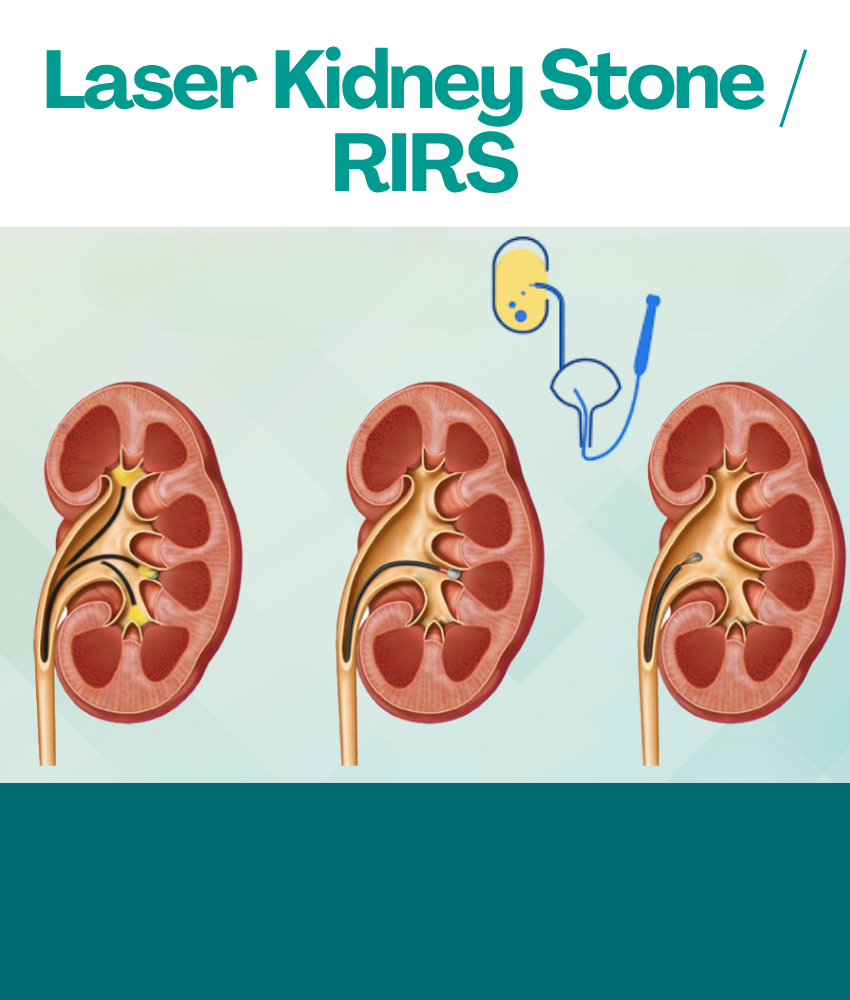 Best Laser kiney stone / RIRS by Dr.Srikant Munna