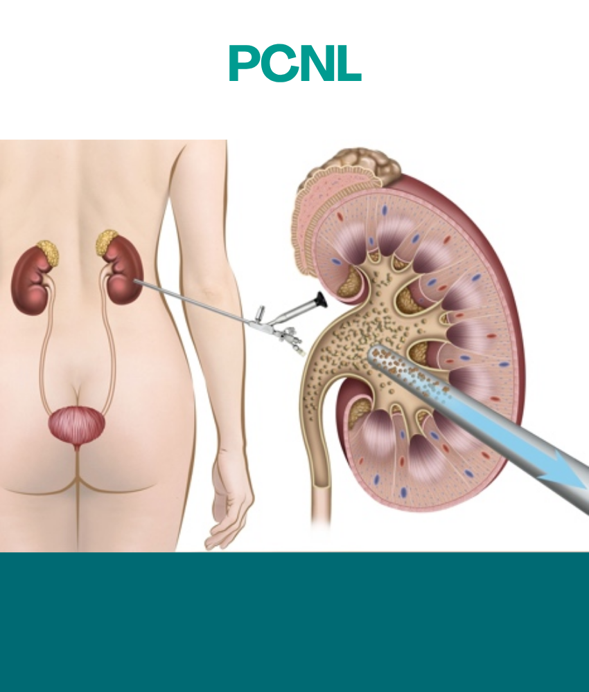 PCNL