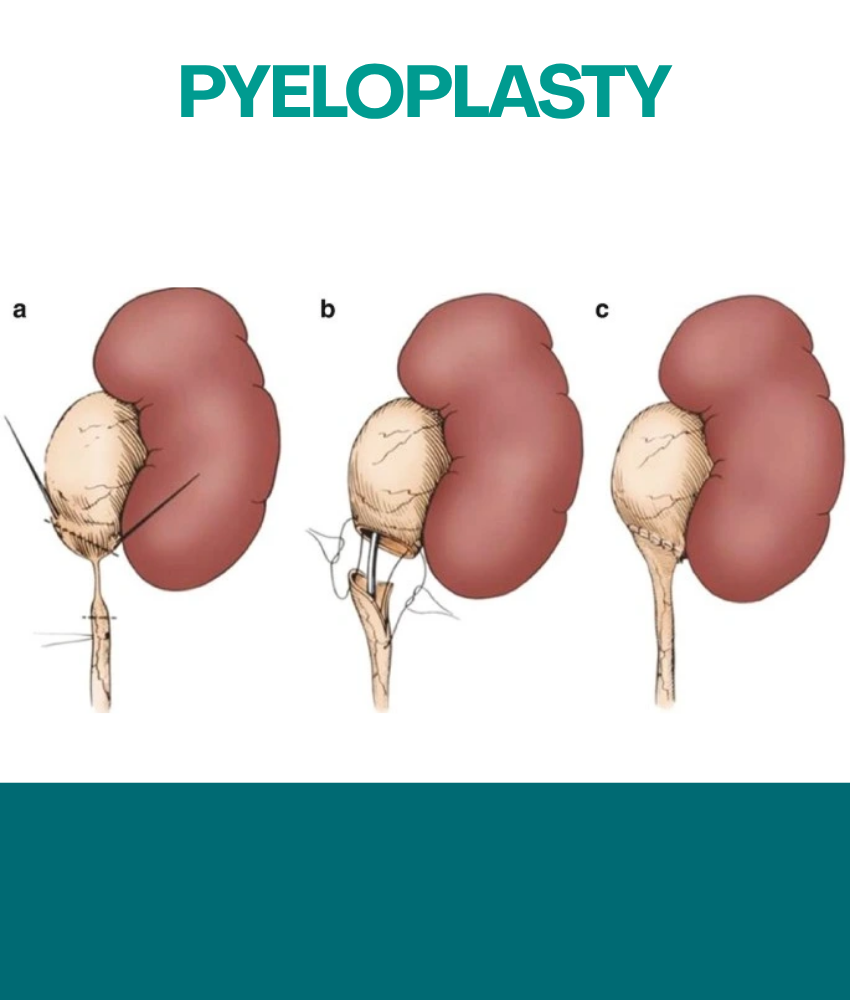 PYELOPLASTY
