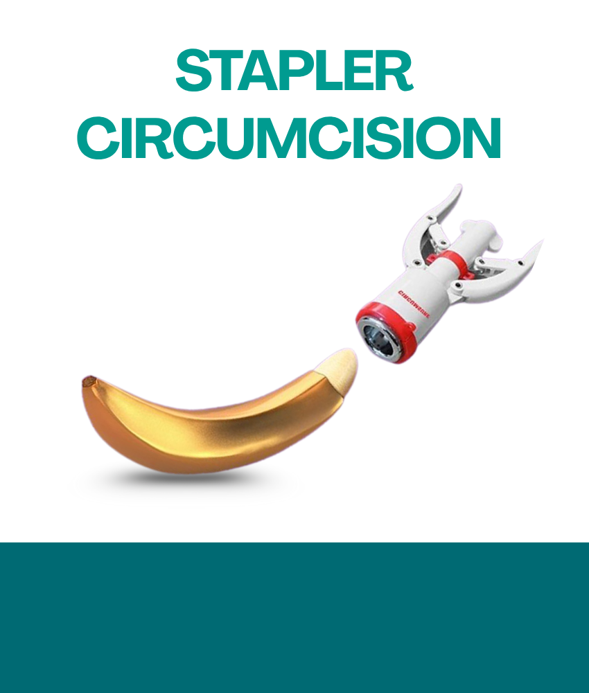 STAPLER CIRCUMCISION