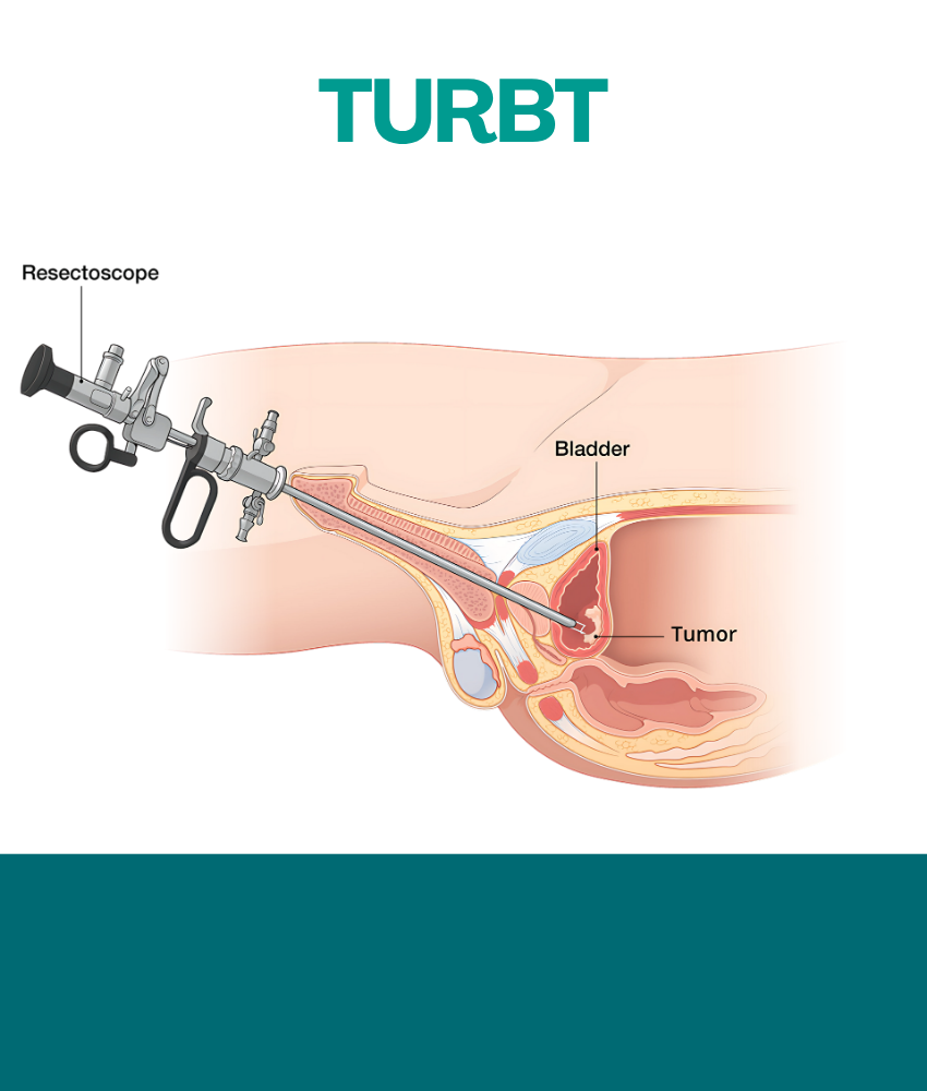 TURBT