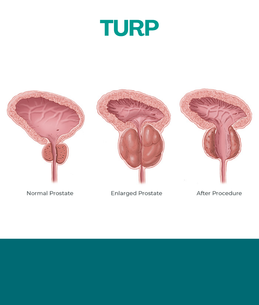 TURP